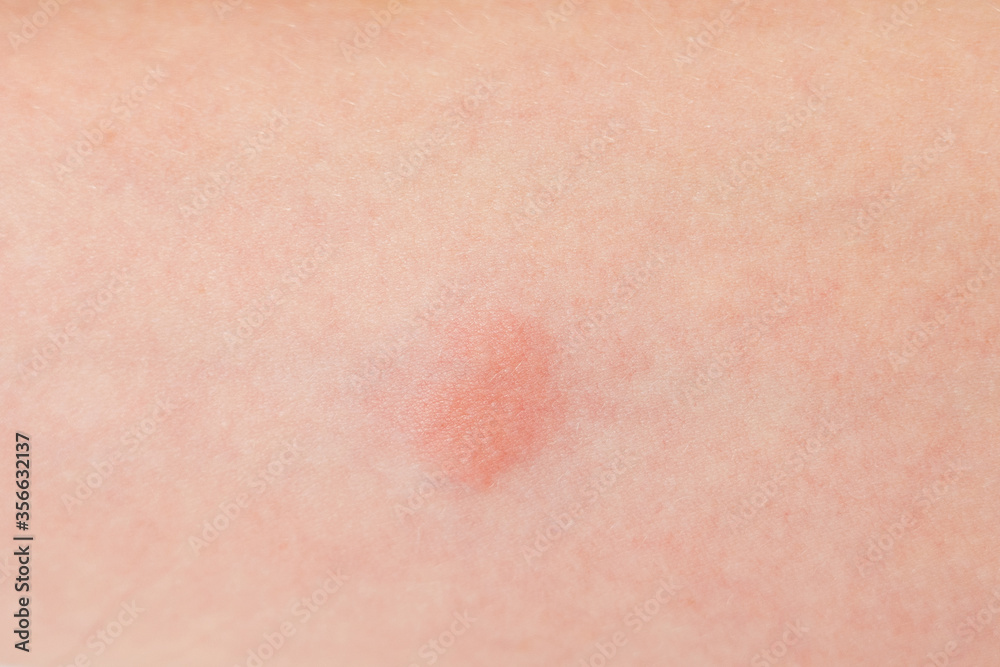 Closeup view photography of caucasian kid's arm with red spot reaction to conducting Mantoux test after 72 hours from injection.