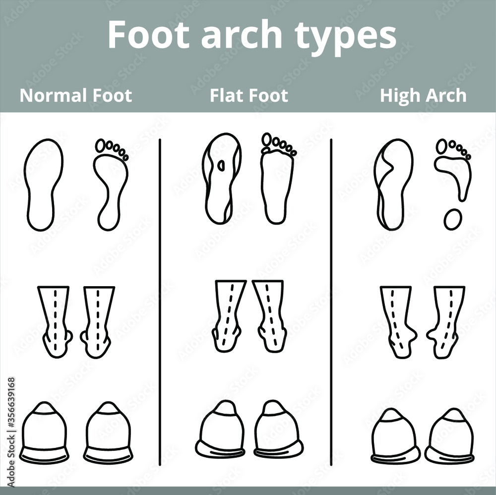 Foot arch types vector infographics. Set of flat foot, high arch vector