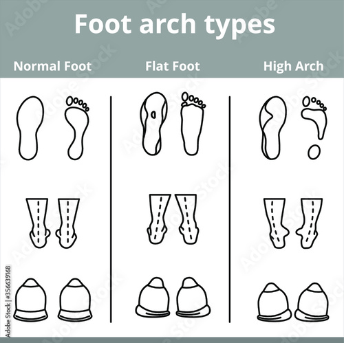 Foot arch types vector infographics. Set of flat foot, high arch