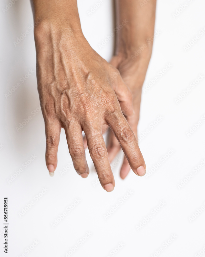 Trigger Finger a defect in a tendon causing a finger to jerk or snap straight when the hand is extended. Trigger Finger a defect in a tendon causing a finger to jerk or snap straight when the hand is extended.