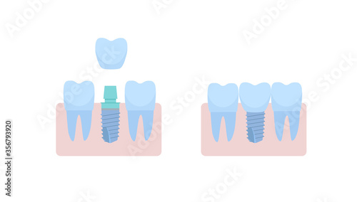 A dental implant placed between two healthy teeth, the abutment is covered with a crown. vector illustration, in a flat style with a thin line. Inside the oral cavity, the gums, the roots