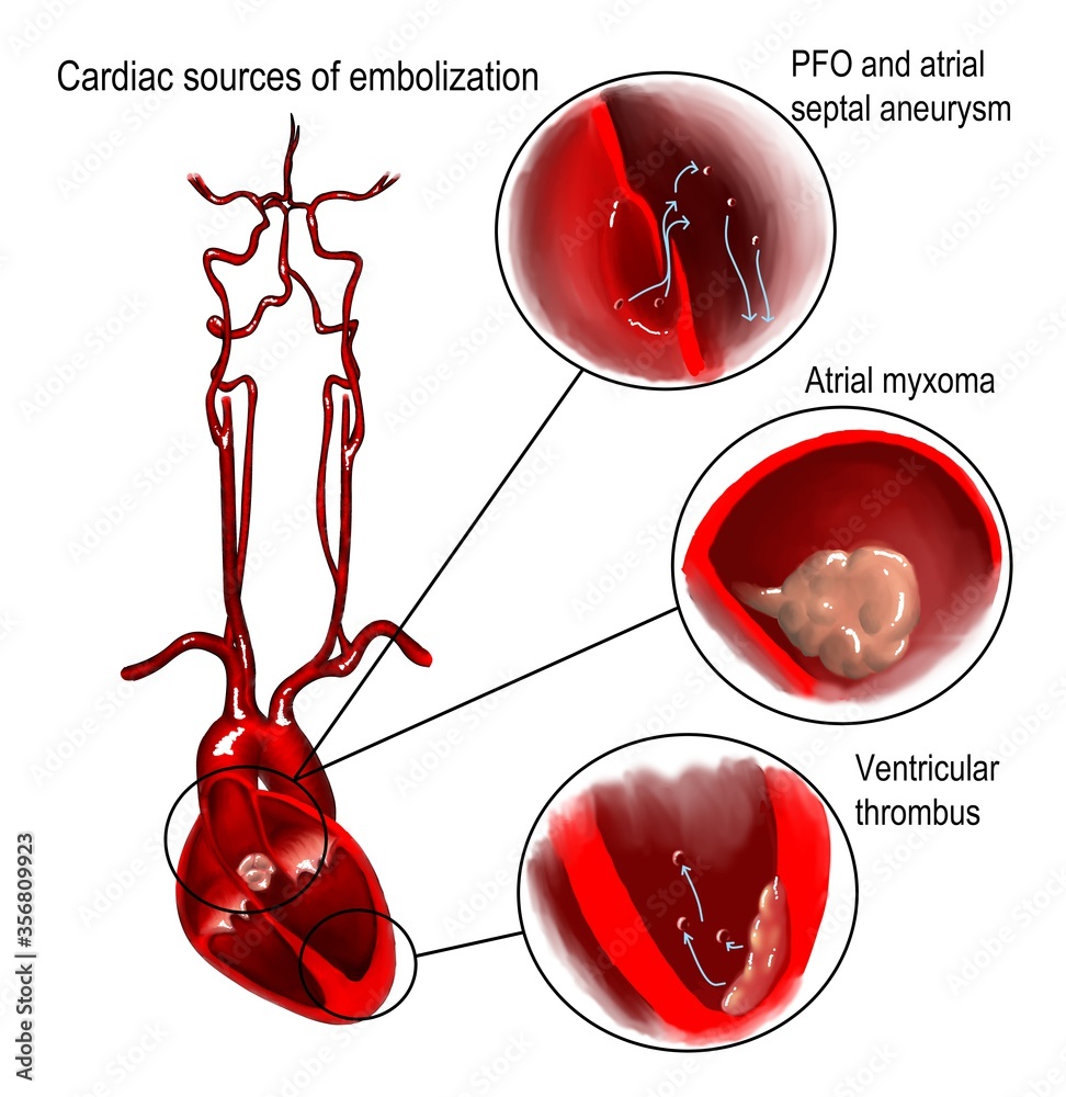ภาพประกอบสต็อก The different courses of cardioembolism leading to ...