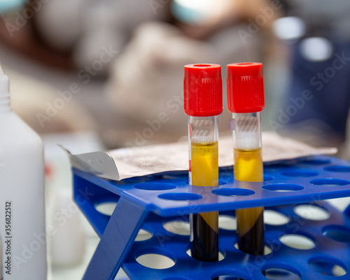 Two test-tubes with plazma in cells, prp laboratory