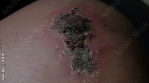 A very close up shot of a scab on a knee photo