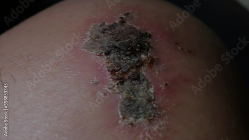 A very close up shot of a scab on a knee