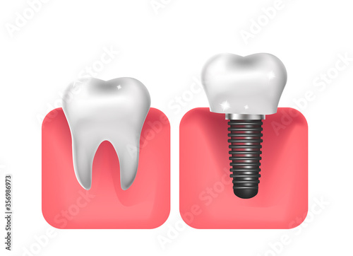 Dental implants, prosthetics 3D realistic style. Dentistry, healthy teeth concept. Vector illustration