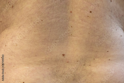 men's back in moles, doctor's examination photo