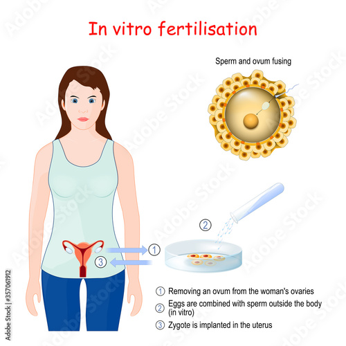 In vitro fertilization (IVF)