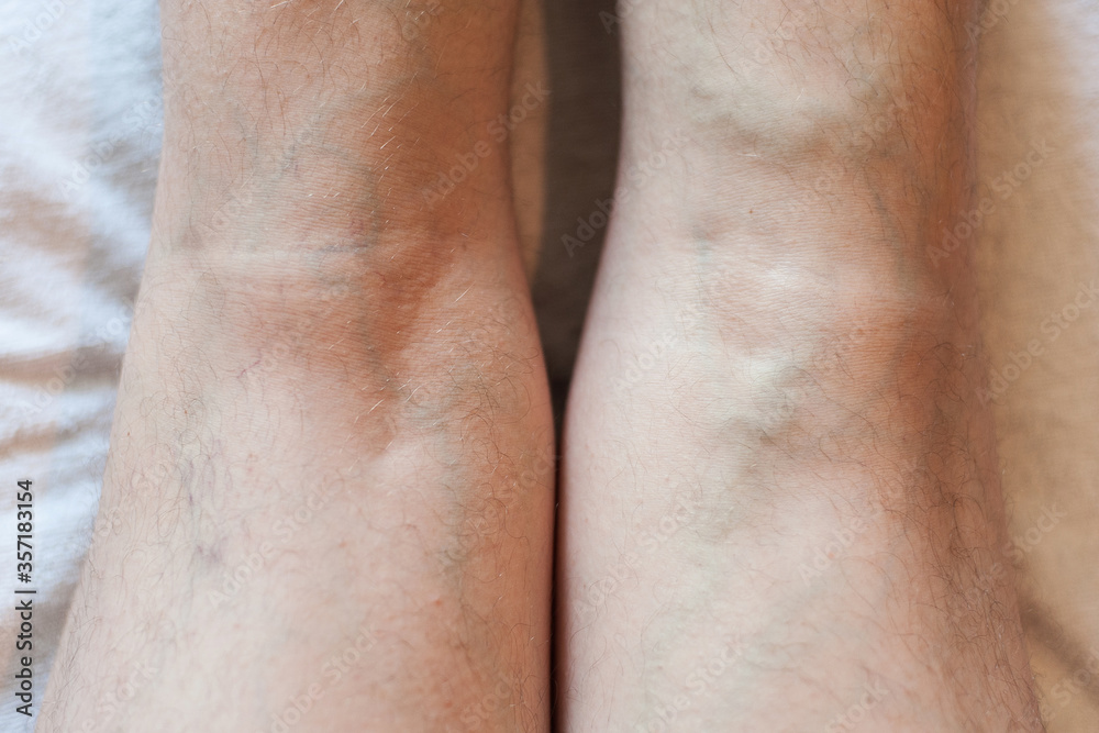 Fototapeta premium Legs of a man with varicose veins on a light background
