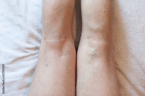 Legs of a man with varicose veins on a light background