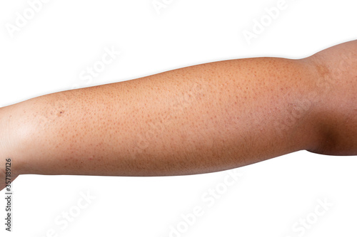 arms have spots on brown skin