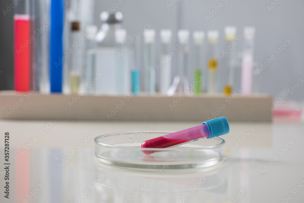 Positive blood test result for the new rapidly spreading Coronavirus, originating in Wuhan, China Positive blood test result for the new rapidly spreading Coronavirus, originating in Wuhan, China