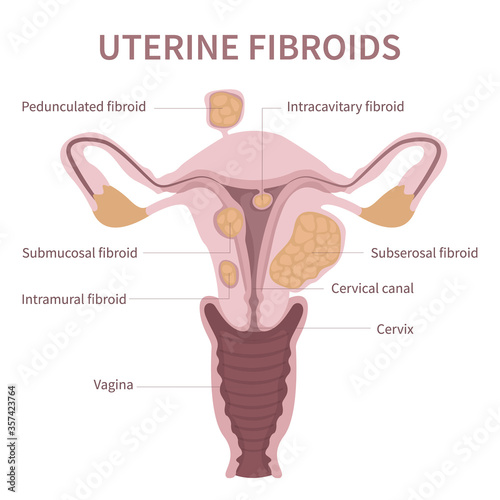 Reproductive system picture displays pedunculated, intracavitary, submucosal, subserosal. Isolated flat vector illustration of uterine fibroids, myoma, uterine leiomyomas on white background.