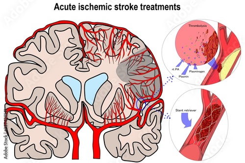 Two important choice of acute ischemic stroke treatment. photo