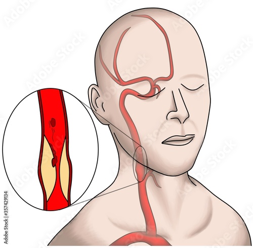 Carotid stenosis and cerebral embolization. photo
