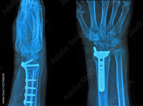 Xray of hand
