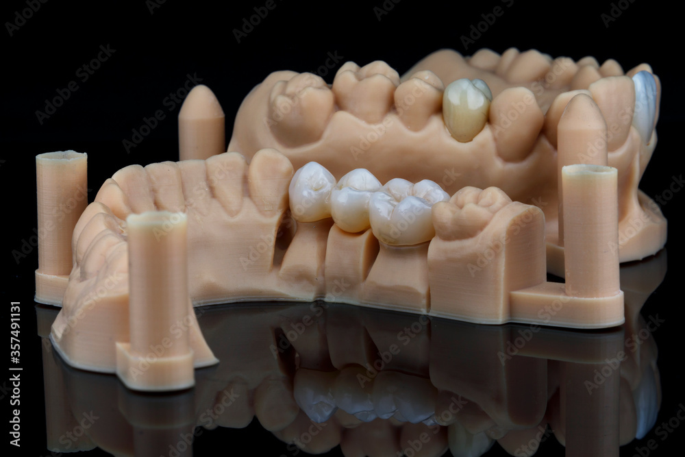beautifully laid out dental models and zircon crowns mounted on models on a black background - obrazy, fototapety, plakaty 