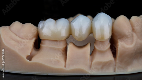 zirconium dental crowns on a model made on a 3D printer, shot on black glass with reflection photo