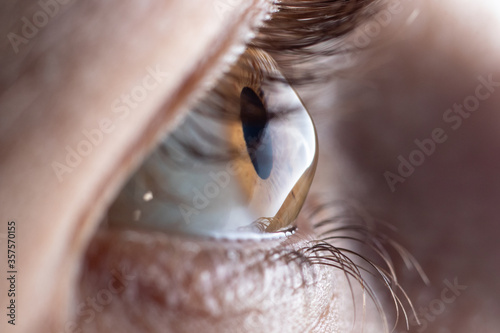 Macro eye photo. Keratoconus - eye disease, thinning of the cornea in the form of a cone. The cornea plastic photo
