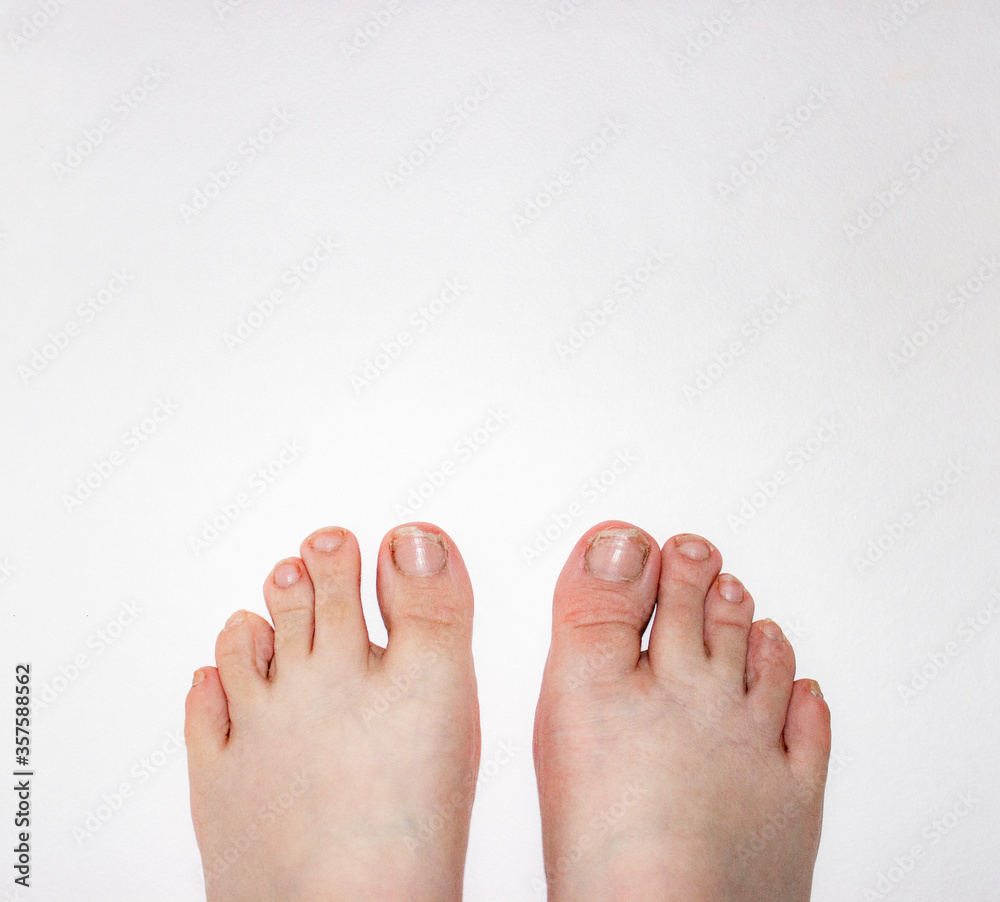 Feet with damaged nails, no pedicure. Regrown toenails and cuticles. Female teenagers, small size. On a solid white background. A disease of the nail plate by a fungus. Feet with damaged nails, no pedicure. Regrown toenails and cuticles. Female teenagers, small size. On a solid white background. A disease of the nail plate by a fungus.