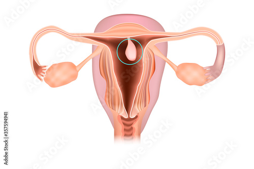 Endometrial polyp or uterine polyp. photo