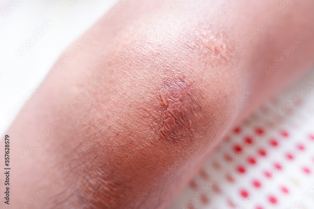 Bad skin condition because of injury in knee and then caused dermatology issue, keloid, overgrowth of scar tissue Bad skin condition because of injury in knee and then caused dermatology issue, keloid, overgrowth of scar tissue