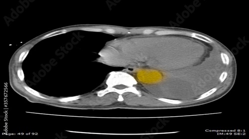 Bilde på lerret CT scan body image Axial view with yellow mark show abnormal enlargement of the