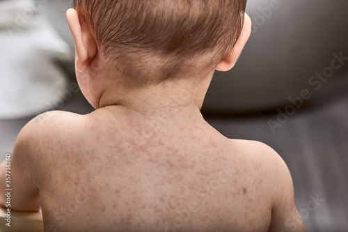 Photos roseola rash a viral rash on the skin of a child
