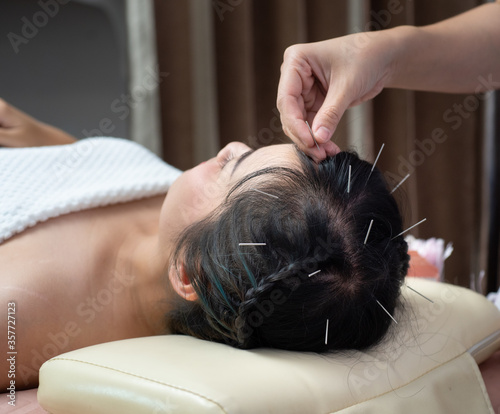 Acupuncture to the head .hair Glabrous