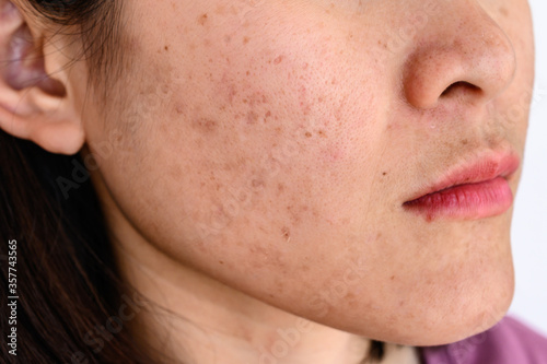 Принти на полотні Woman face has variety problems on her skin (such as Acne, Pimple, Pores and Melasma etc)