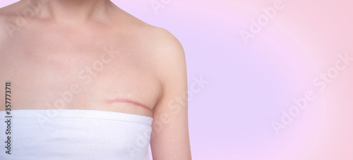 Breast cancer surgery scars by partial mastectomy.  She can wear a tube top or tube dress and strapless with confident. With effect filter.