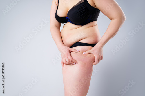 Overweight woman with fat thighs, obesity female legs