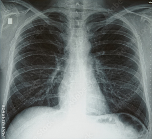 Фотография Plain chest x-ray, normal healthy lungs