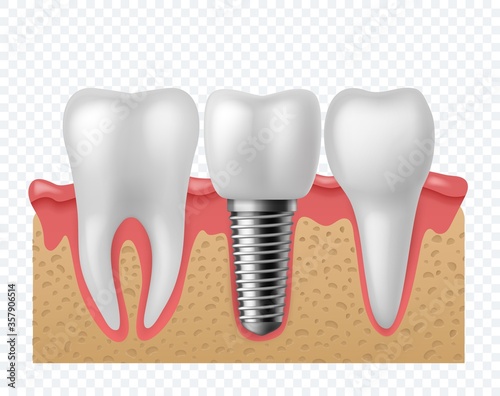 Tooth implant. Human teeth and dental implant, denture orthodontic technology. Artificial teeth dentistry implantation jaw vector concept