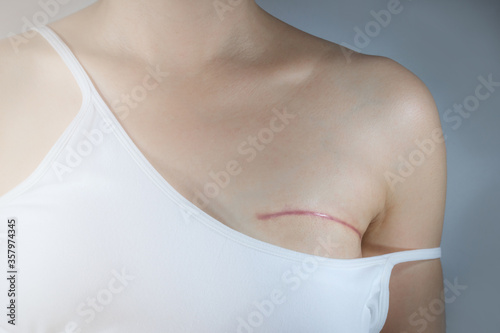 Breast cancer surgery scars by partial mastectomy. Woman shows scar from mastectomy of operation of her breast cancer. She can wear a tube top or tube dress and strapless with confident.  photo