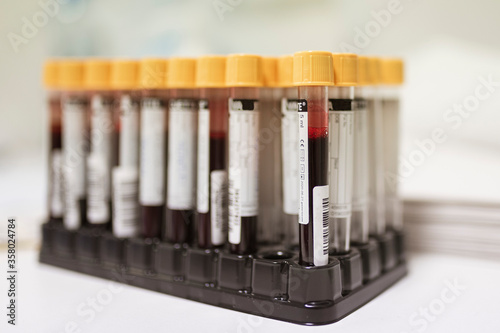 Real blood samples taken for coronavirus testing