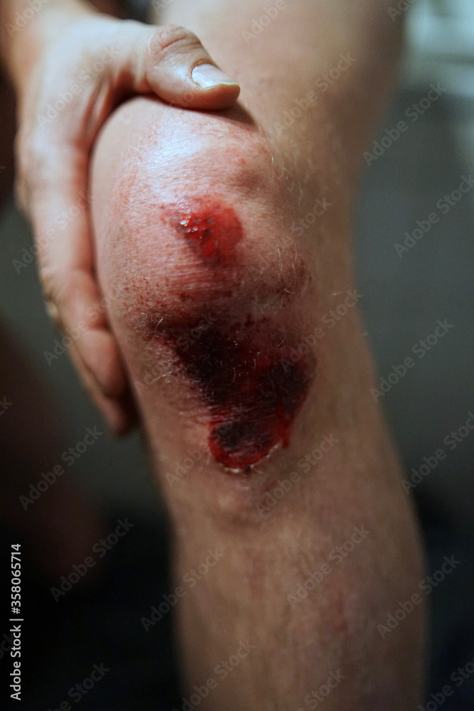Fototapeta premium Scratched knee after accident, open wound with blood 