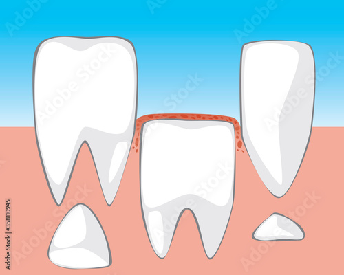 A permanent tooth grows from the gums of a child’s mouth, a flat vector stock illustration with molars and incisors as a concept of changing milk teeth to permanent