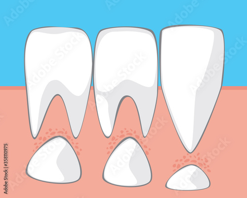 Milk molars in a child’s mouth, flat stock vector illustration with molars and incisors as a concept of changing milk teeth to permanent