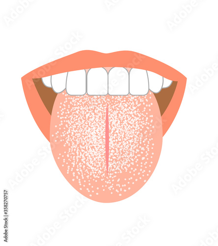 Illustration of tongue symptoms and health