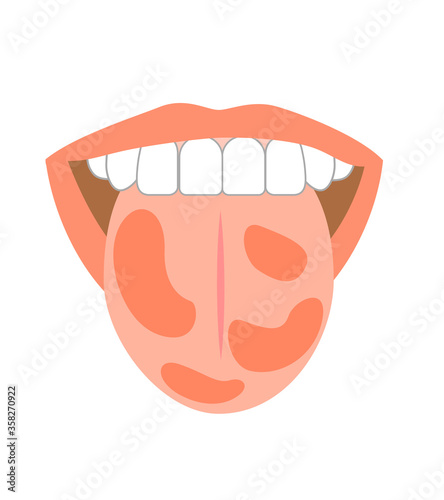 Illustration of tongue symptoms and health