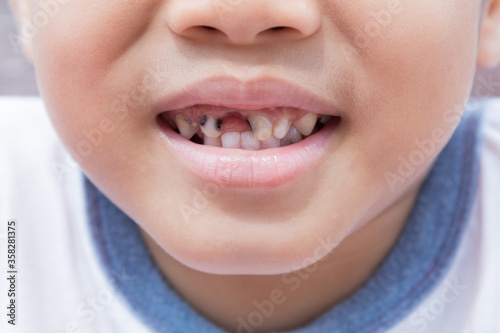Asian little boy with decayed teeth with smiling