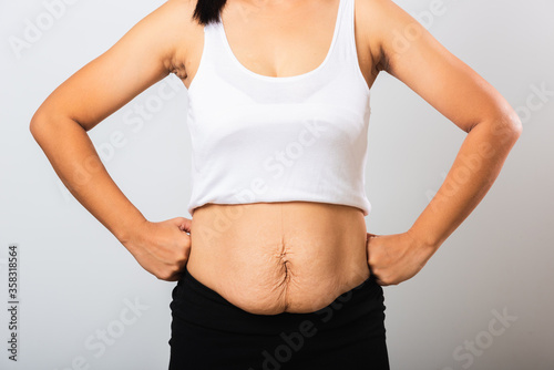 Obraz na plátne Close up of Asian mother woman showing stretch mark loose lower abdomen skin she
