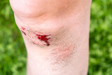 Fresh untreated bleeding wound on the knee with cleansed skin, bruises and bruises. Selective focus. Close-up.