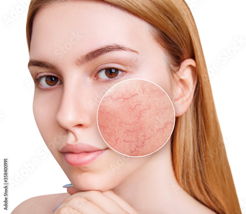 Young woman with couperose on face skin. Zoom circle shows skin problems. Isolated on white.