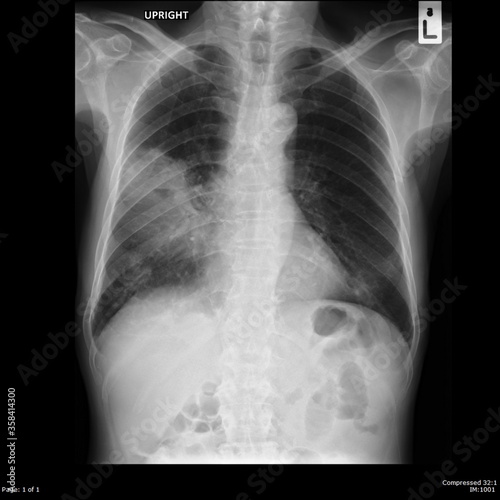 X-Ray chest lung Male 77year old abscess lung with pneumonia
