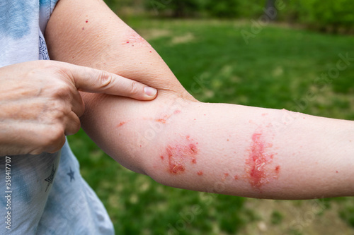 Severe poison ivy poison oak rash and boils and blisters on woman's arm. Itchy scratchy pain