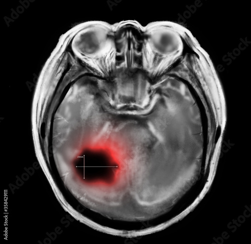 X-ray of patient with brain cancer. Illustration