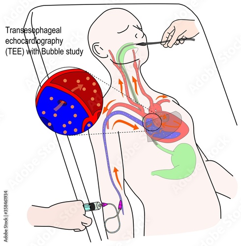 Trans esophageal echocardiography (TEE) is one of the test for PFO and shunt finding.