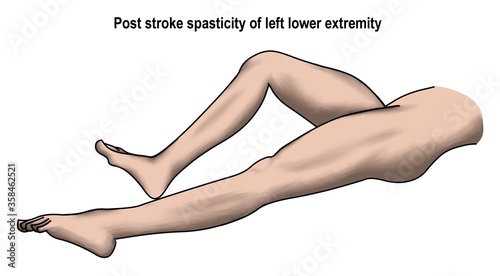The left leg spasticity from right hemispheric stroke. photo
